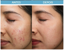 Kit Solução Total Anti acne e Oleosidade Cuidado Facial Completo