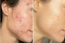 Dermachem Sérum Efeito Secativo cravos e espinhas
