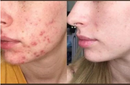 Sérum Facial Controle de Acne, Oleosidade, Cravos e Espinhas