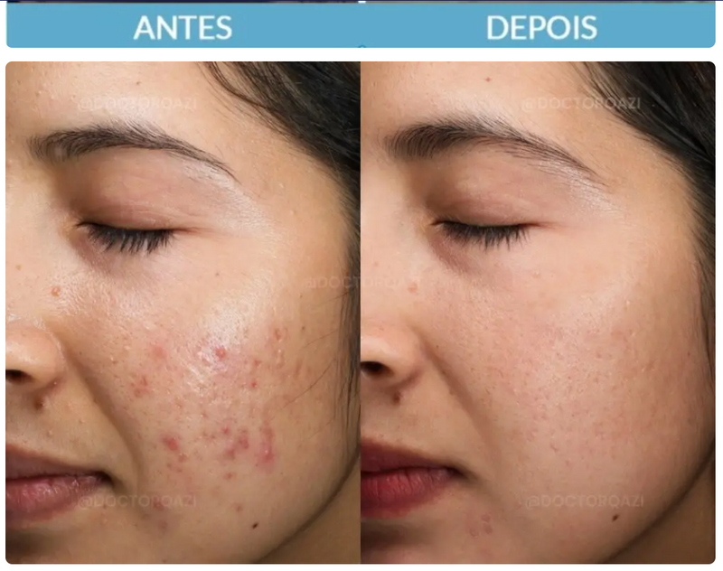 Kit Solução Total Anti acne e Oleosidade Cuidado Facial Completo