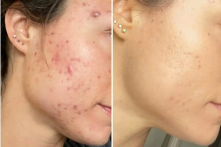Dermachem Sérum Efeito Secativo cravos e espinhas